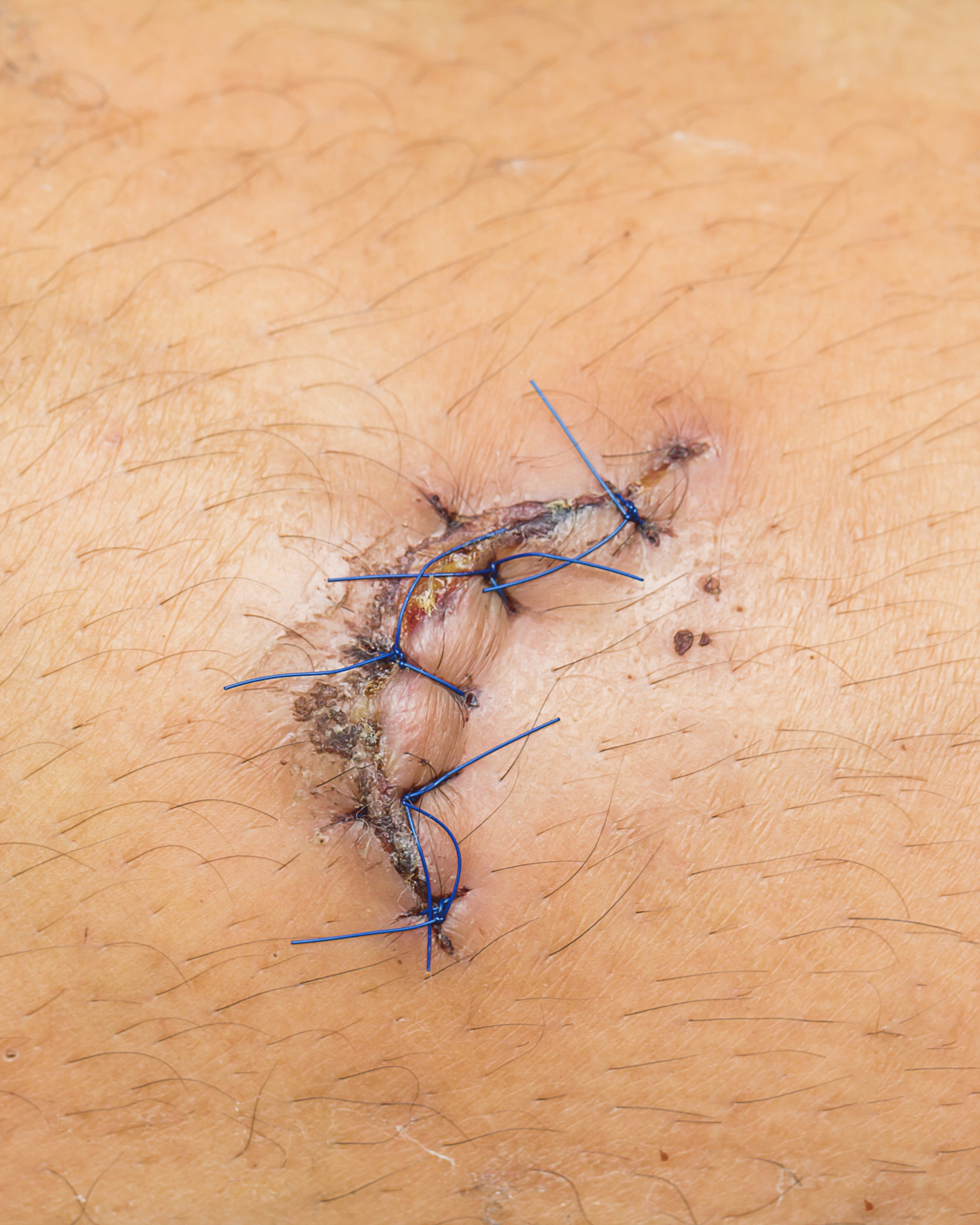 Usuwanie zmian skórnych