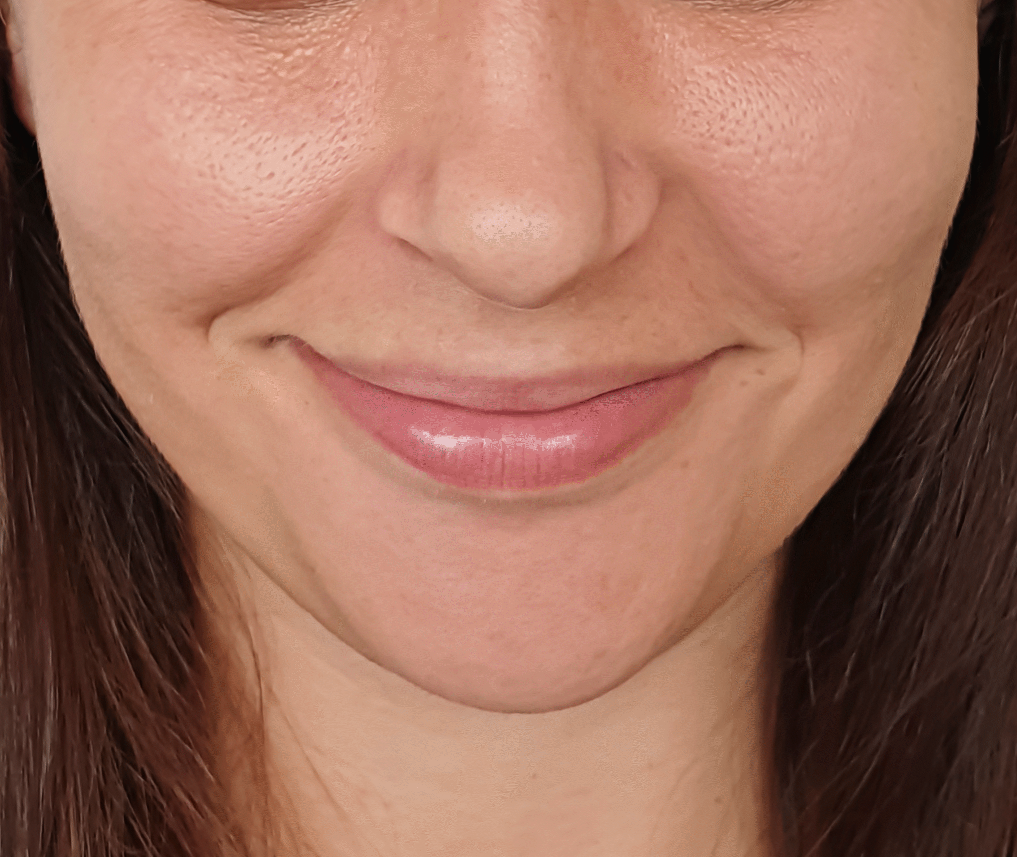 Chirurgiczny lip lift