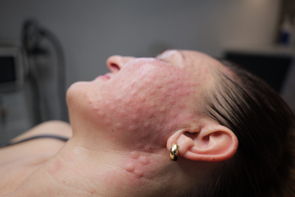 mezoterapia