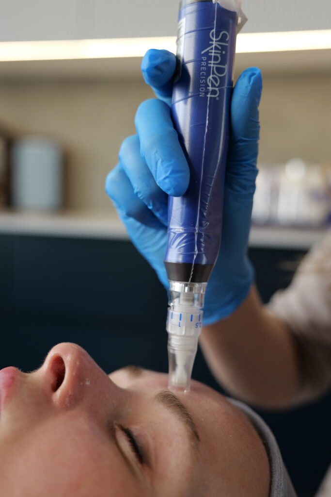 TOP 3 zabiegi dla skór 30+, czyli mezoterapia mikroigłowa, mezoterapia igłowa i radiofrekwencja mikroigłowa mezoterapia mezoterapia