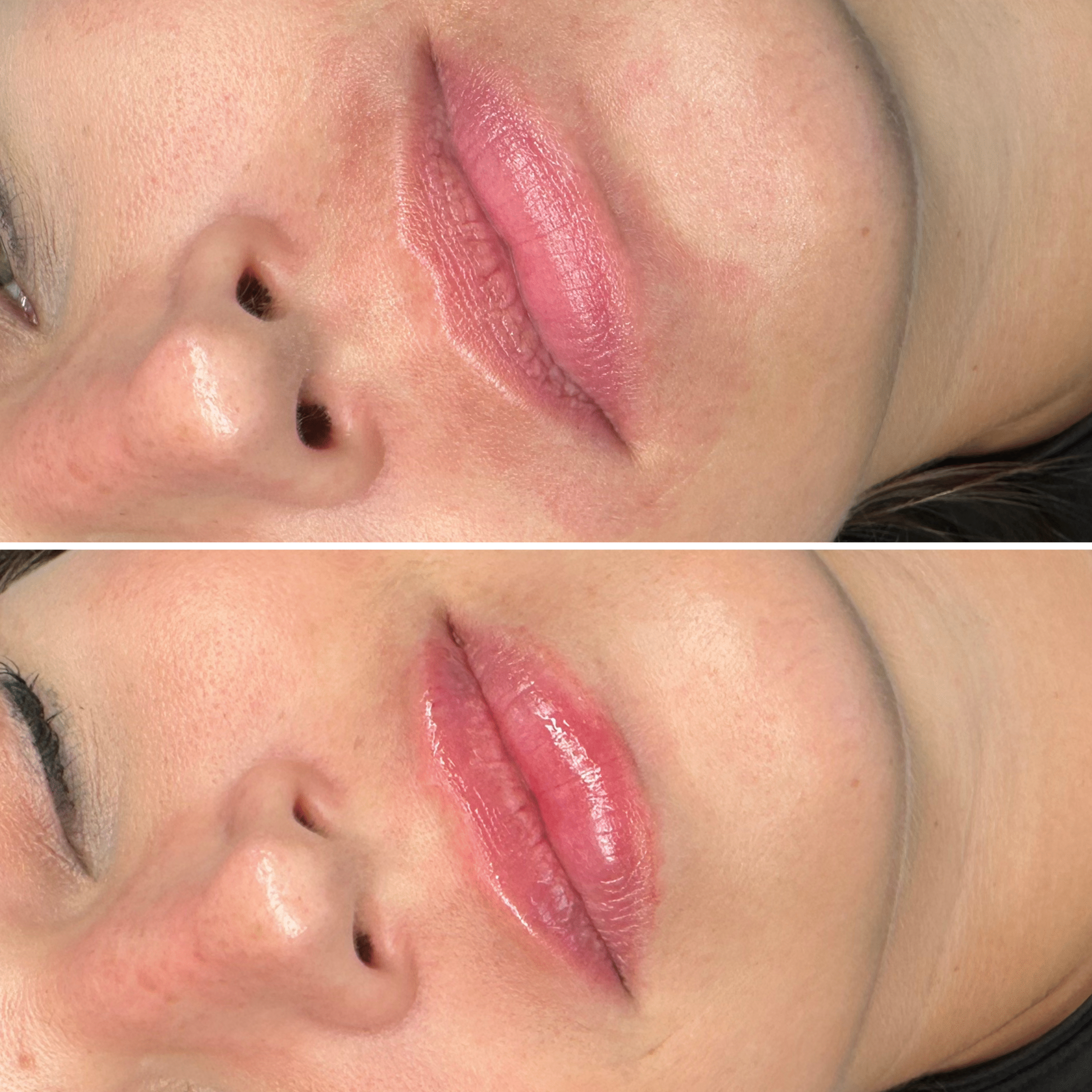 lip lift chirurgiczny