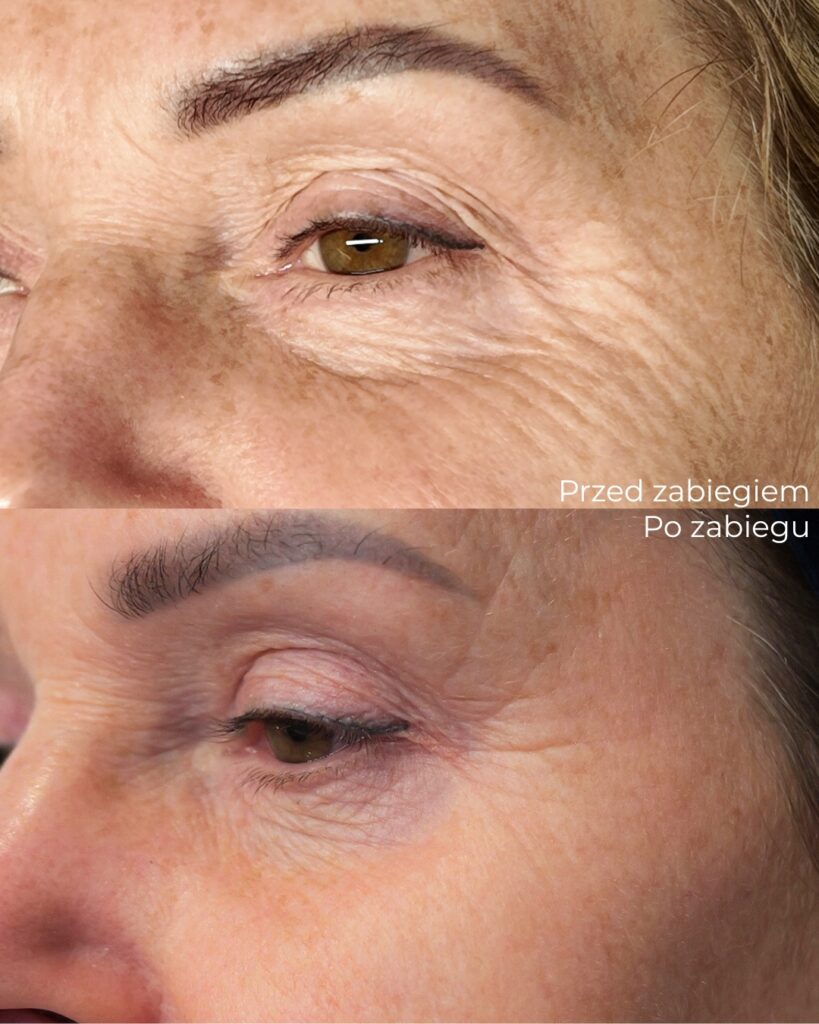 blefaroplastyka
