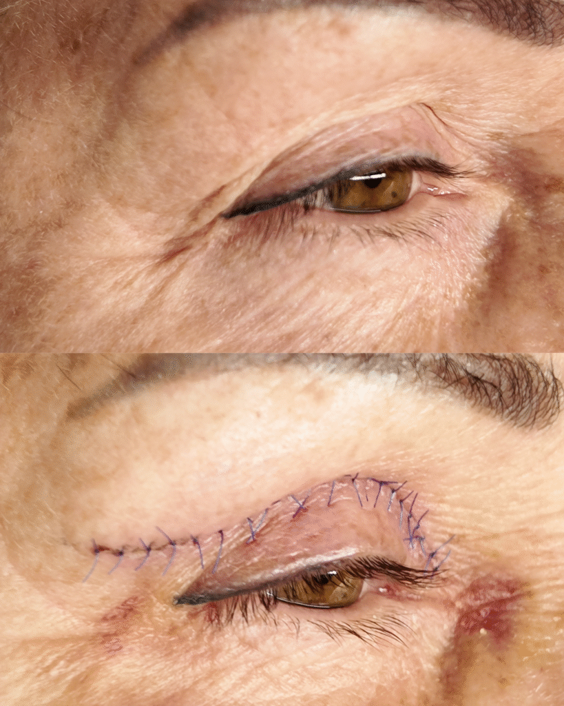 blefaroplastyka