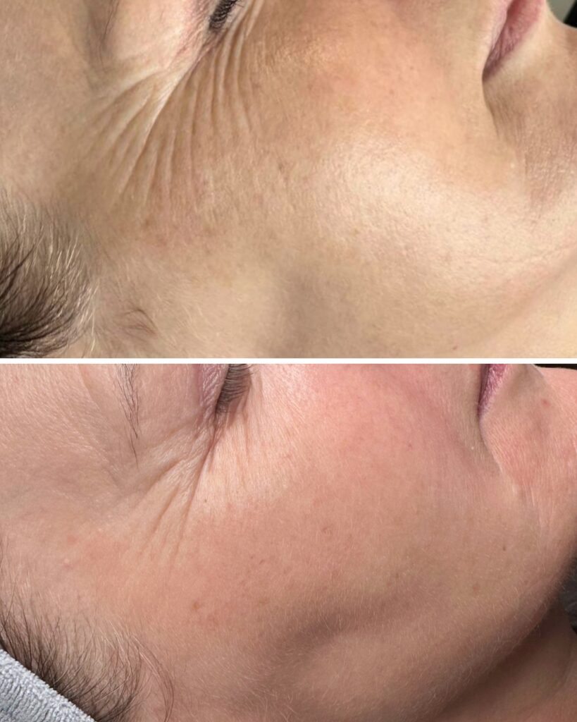 dlaczego okolica oka zdradza nasz wiek