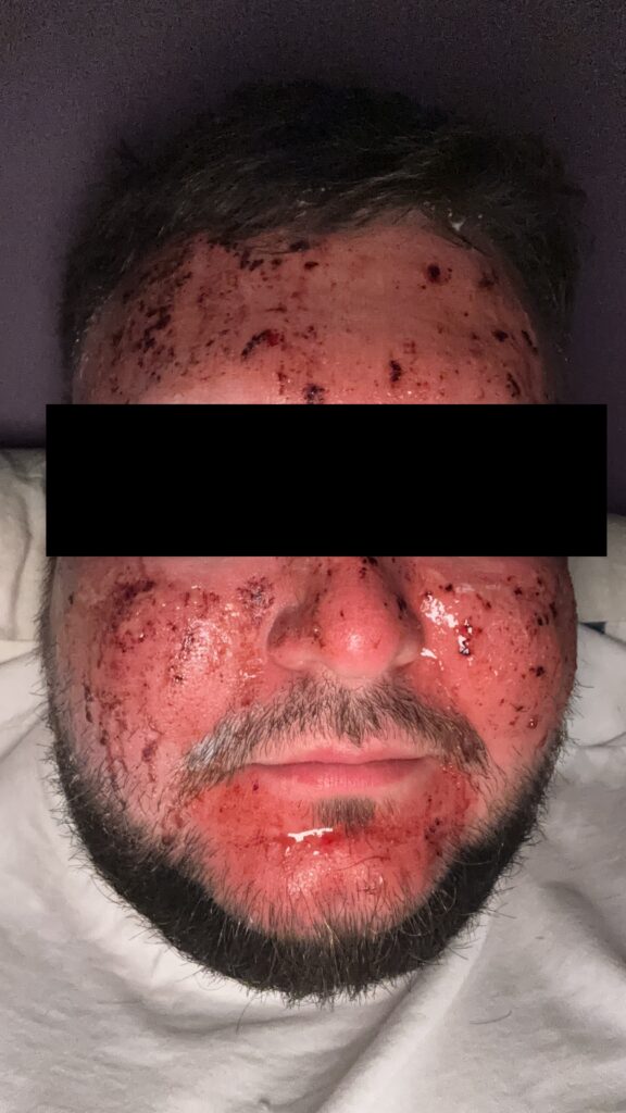 głęboki resurfacing laserowy