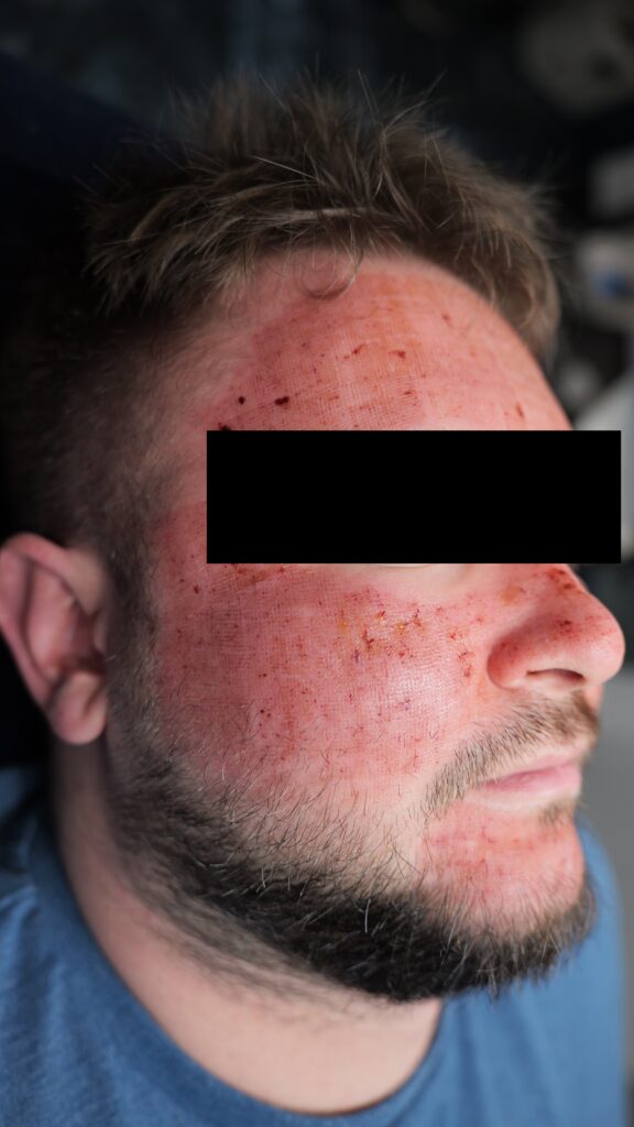 Zabieg laserowy - co trzeba wiedzieć przed ? zabieg laserowy zabieg laserowy