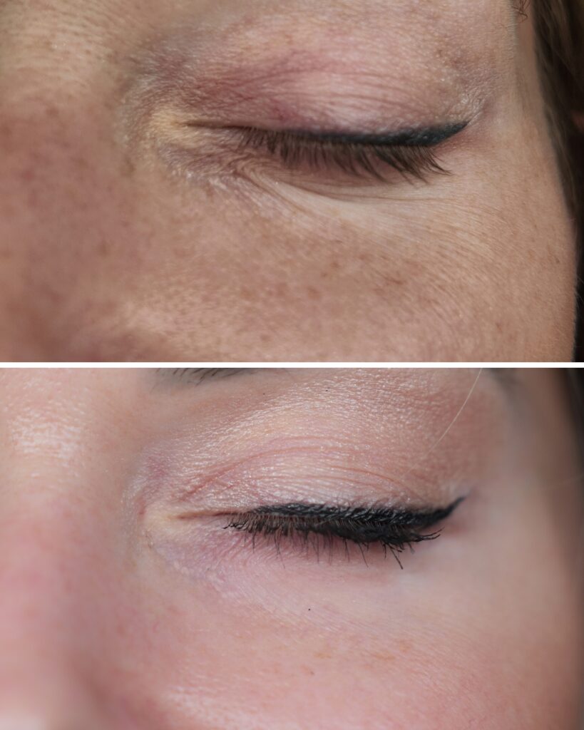 dlaczego okolica oka zdradza nasz wiek