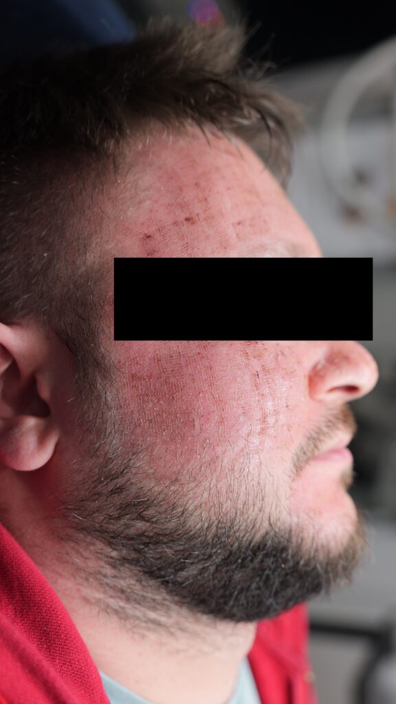 głęboki resurfacing laserowy