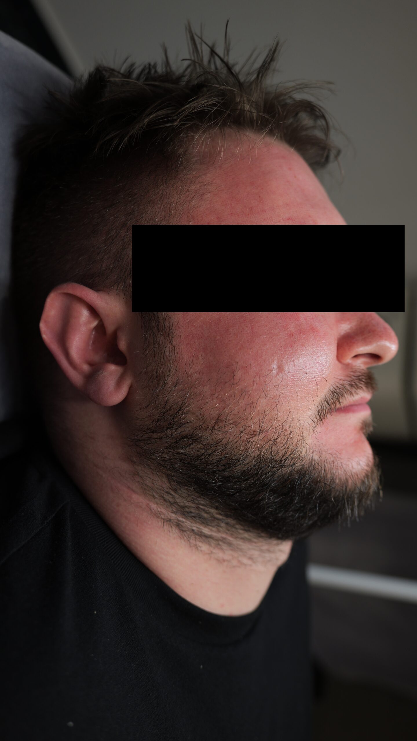 głęboki resurfacing laserowy