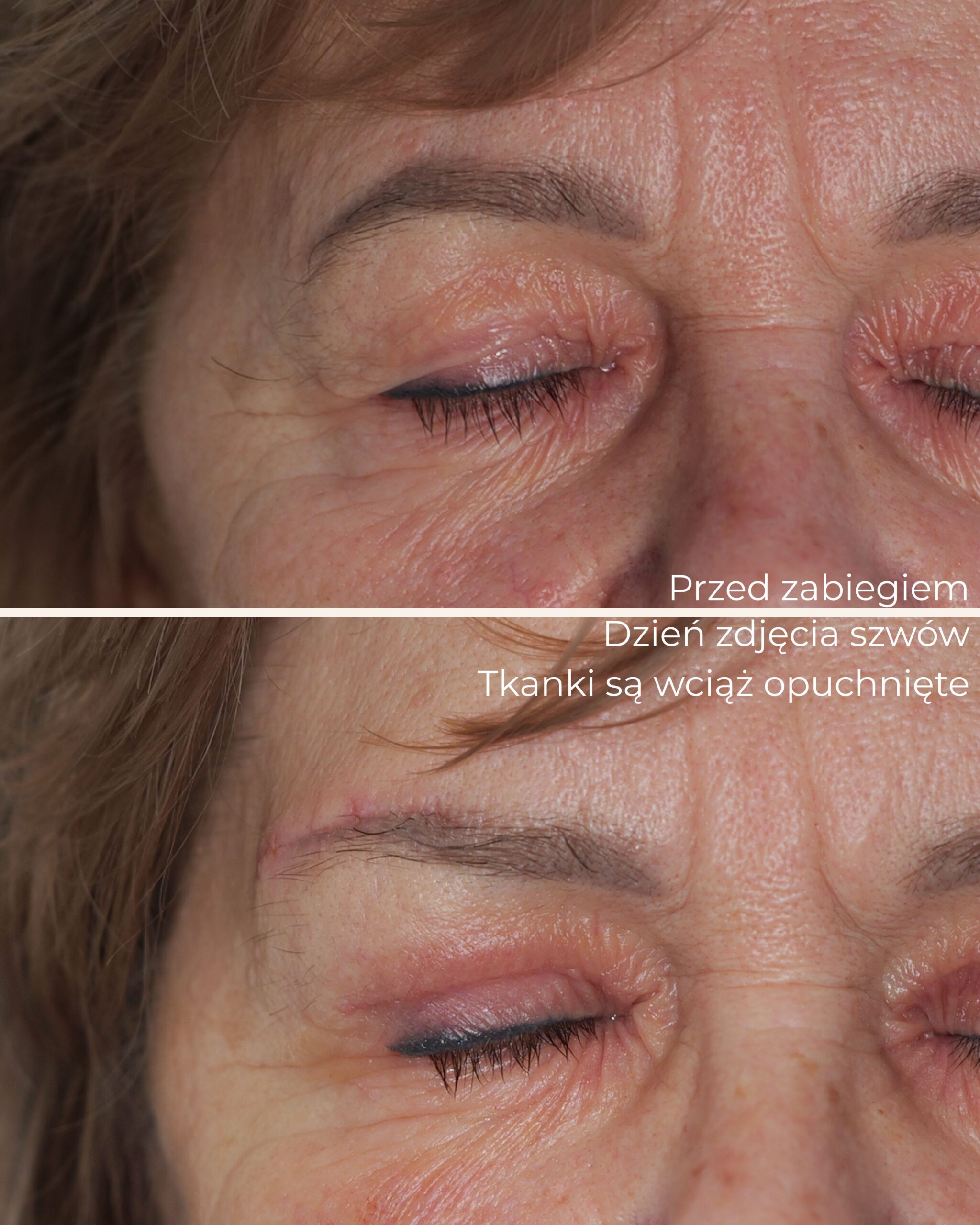 brow lift lifting brwi