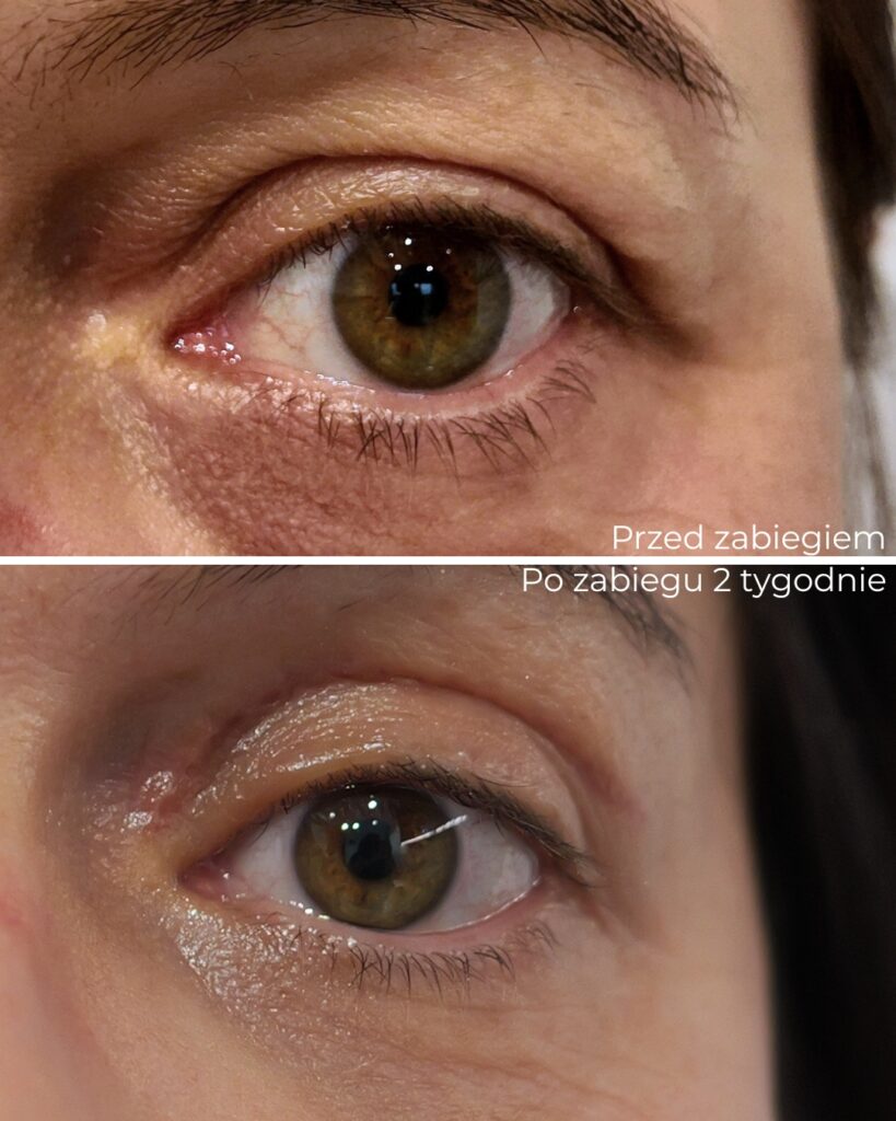 dlaczego okolica oka zdradza nasz wiek