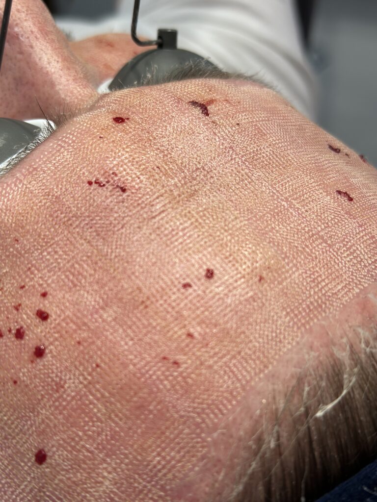 Resurfacing laserowy – różnice pomiędzy laserem CO2, a głębokim resurfacingiem Er:YAG resurfacing laserowy resurfacing laserowy