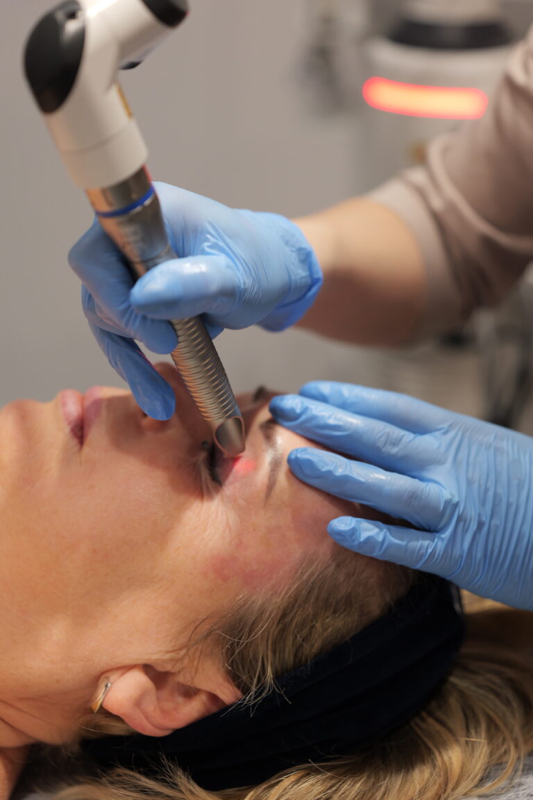 SmoothEye® Laserowy lifting powiek