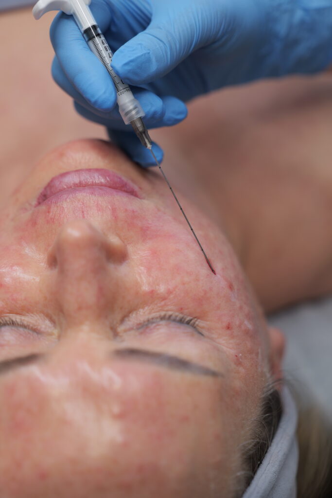 Wolumetria twarzy – przywracanie objętości i proporcji w procesie starzenia wolumetria twarzy wolumetria twarzy