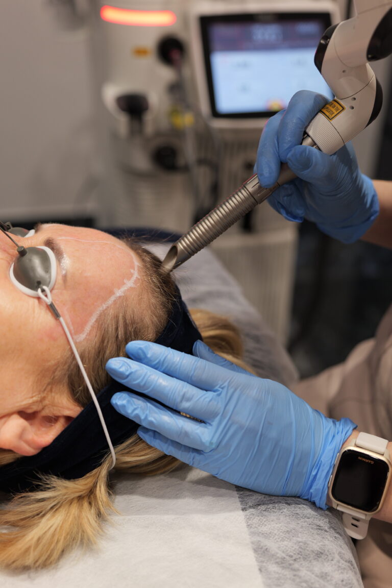 VectorLift® Laserowy lifting powiek i brwi 