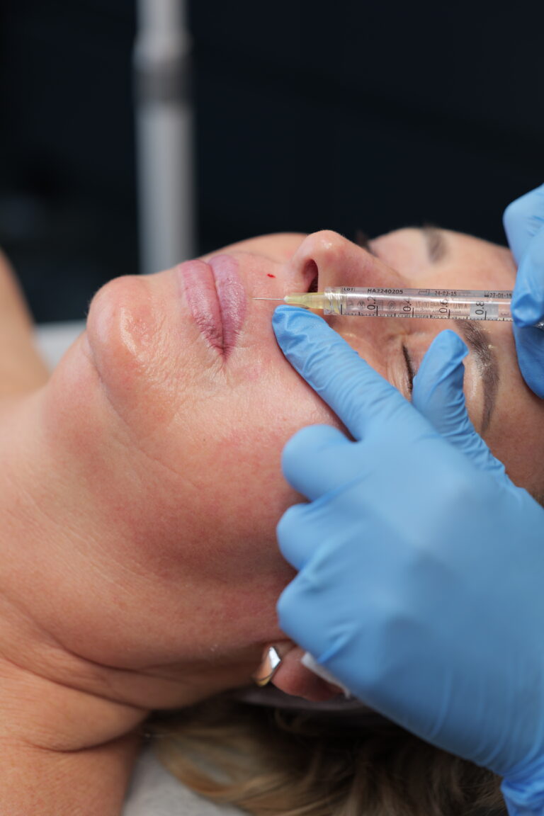 Wypełnianie zmarszczek i bruzd