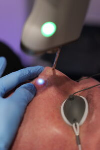 resurfacing laserowy