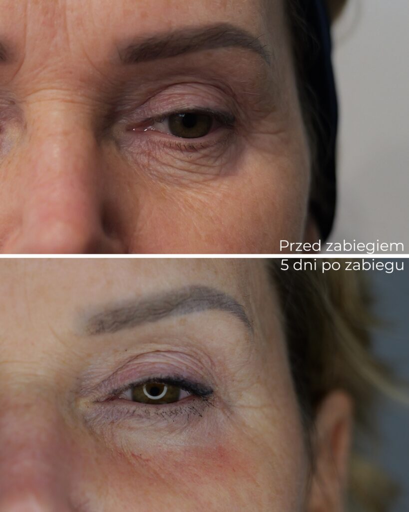 dlaczego okolica oka zdradza nasz wiek