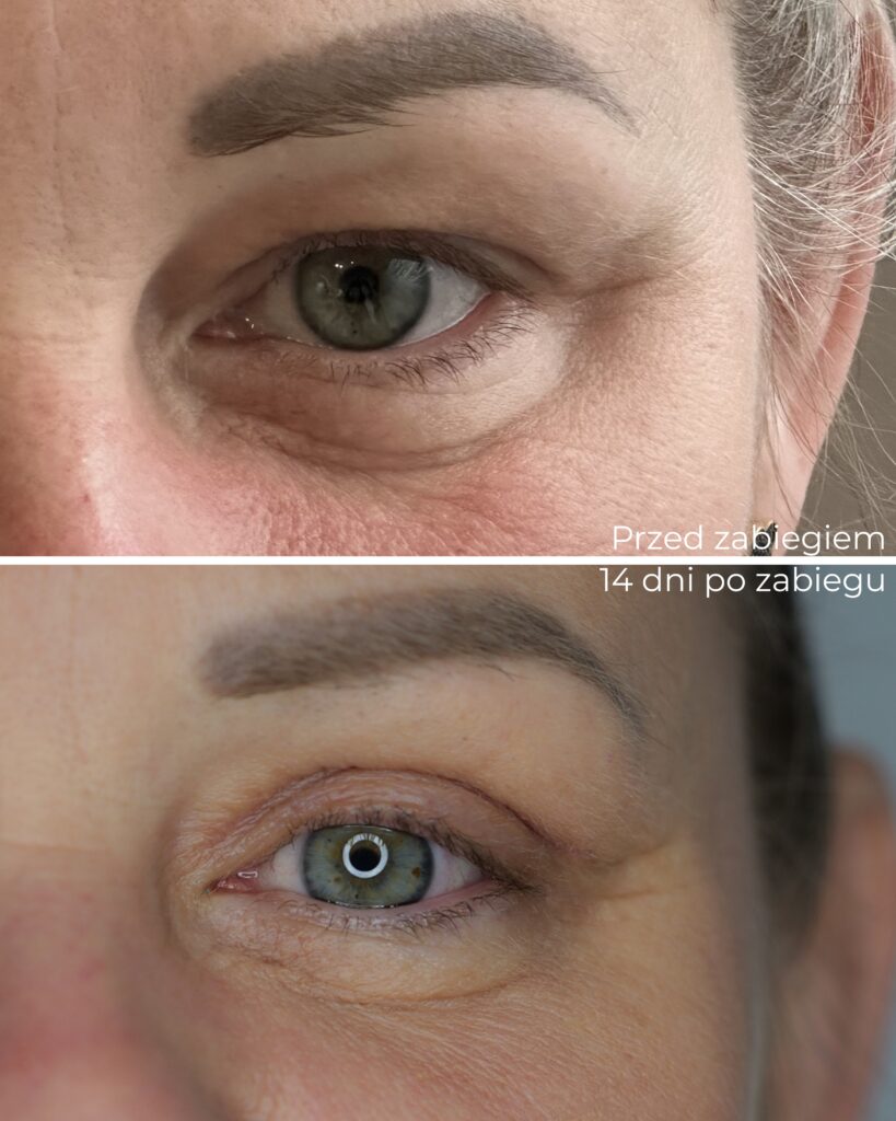 dlaczego okolica oka zdradza nasz wiek